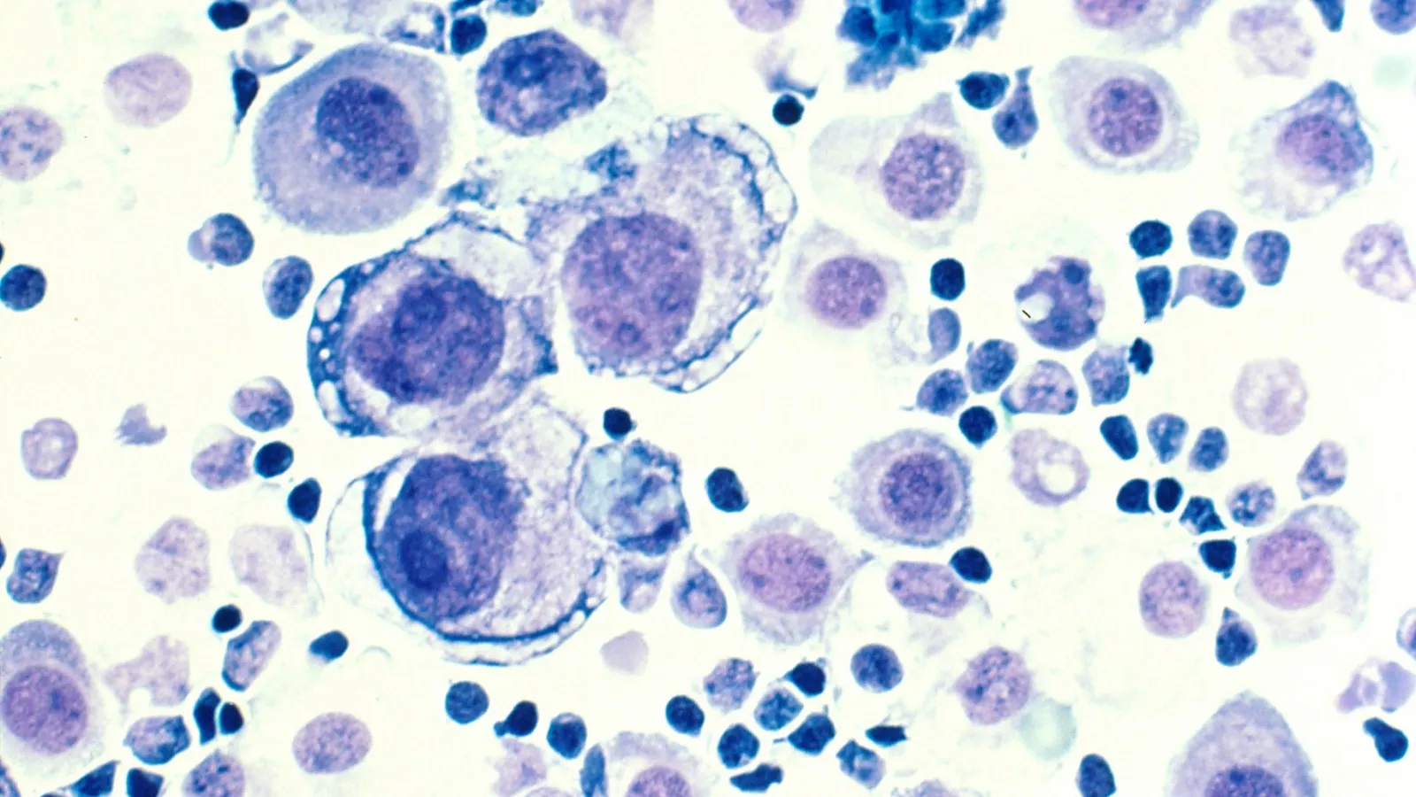 Breast Cancer Cells